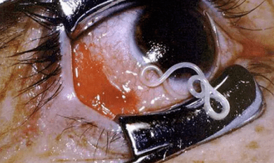 Vrste parazitov v človeškem telesu